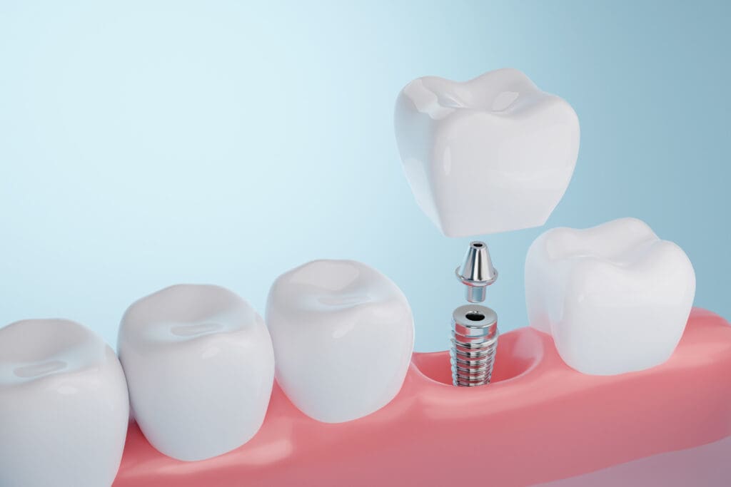Affordable dental implants in Omaha, NE
