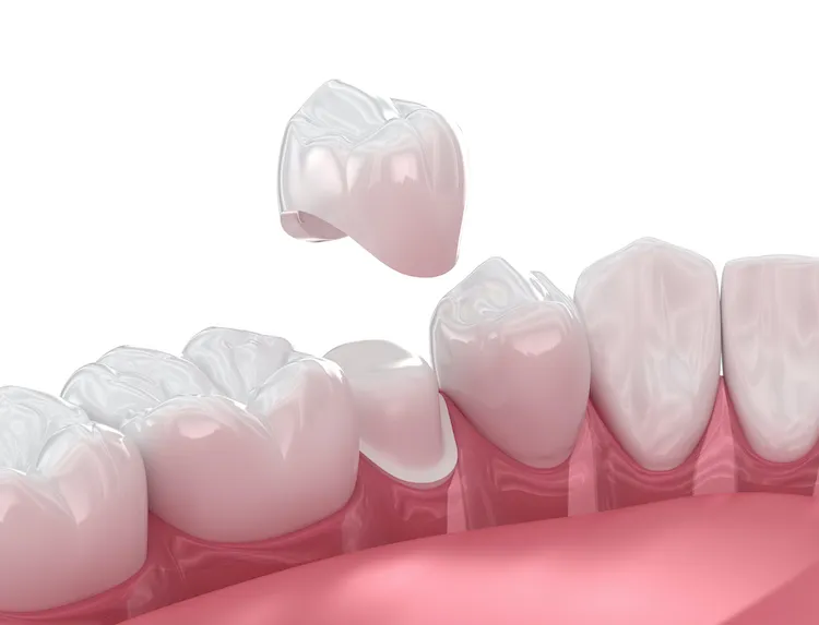 Why an Old Dental Crown Won’t Cut It Anymore in Omaha, NE