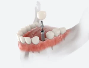 Missing a Tooth? Dental Implants Could Help in Omaha, NE