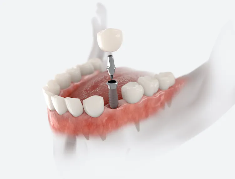 Missing a Tooth? Dental Implants Could Help in Omaha, NE